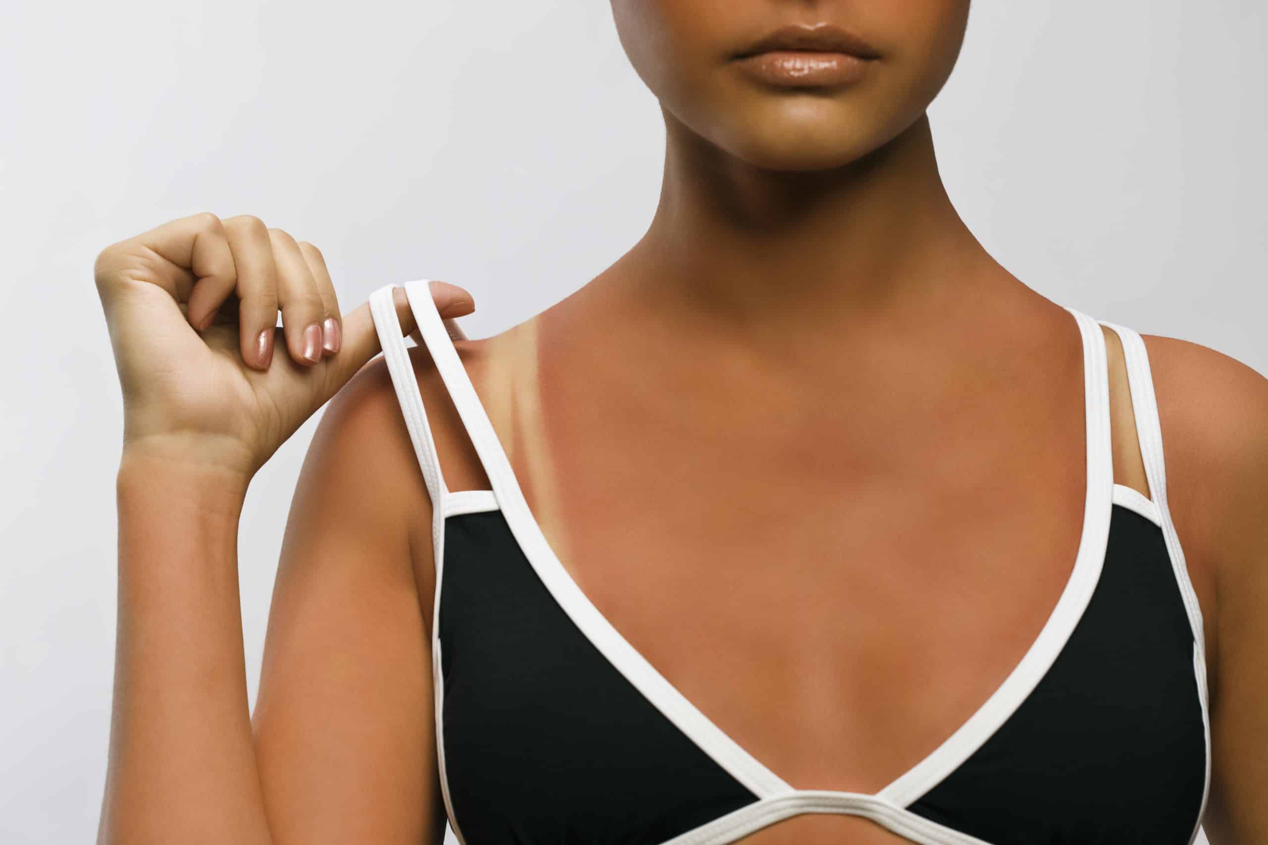 Do Sunburns Turn into Tans? (What You NEED to Know!)